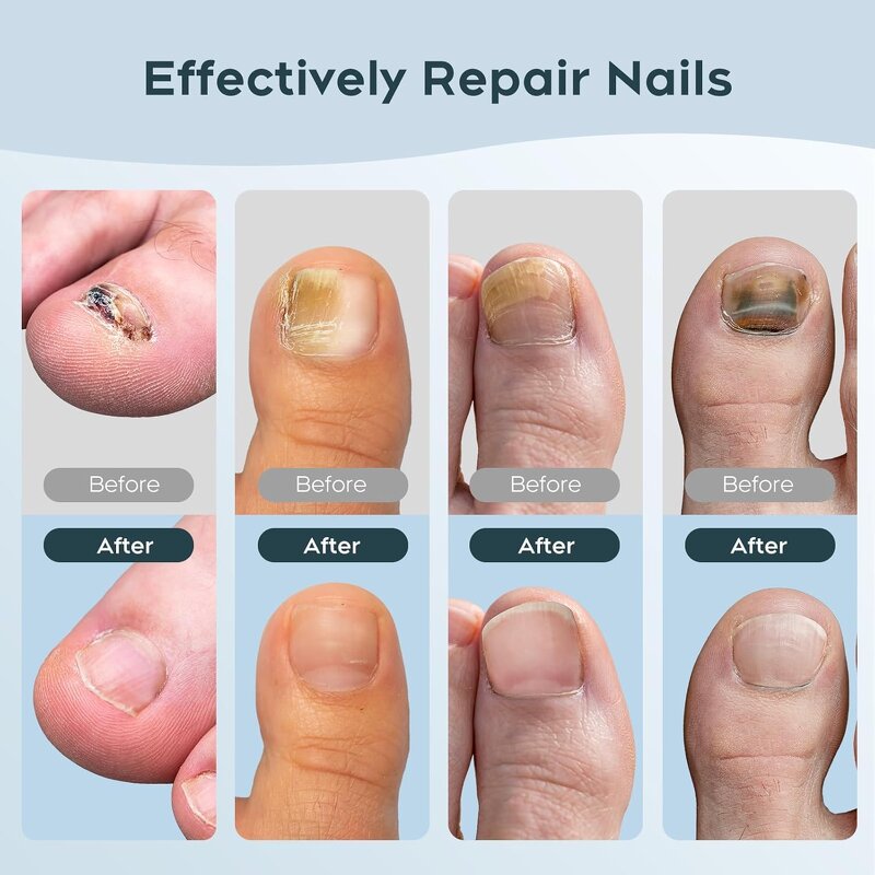 Nail Fungus Lamp - Professional Nail Care Solution Damaged Faded Nails Repair