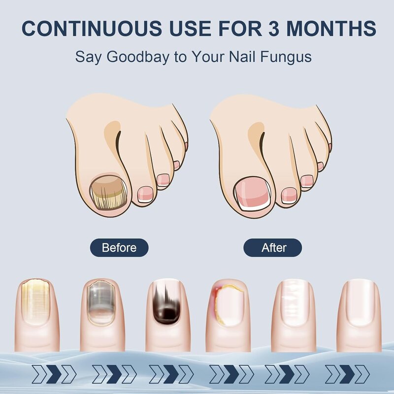 Nail Fungus Therapy Machine - Portable Home Multi-Nail Damaged Yellowed Repair