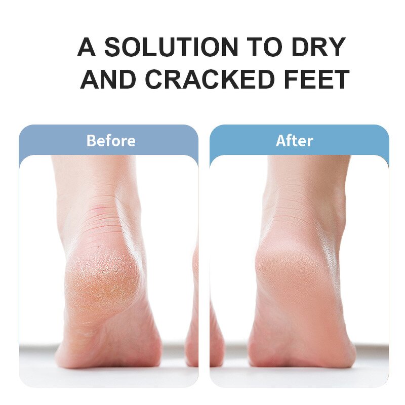 Rechargeable Foot Callus Remover - Electric Dead Hard Skin Trimmer Foot Care Removal Tool