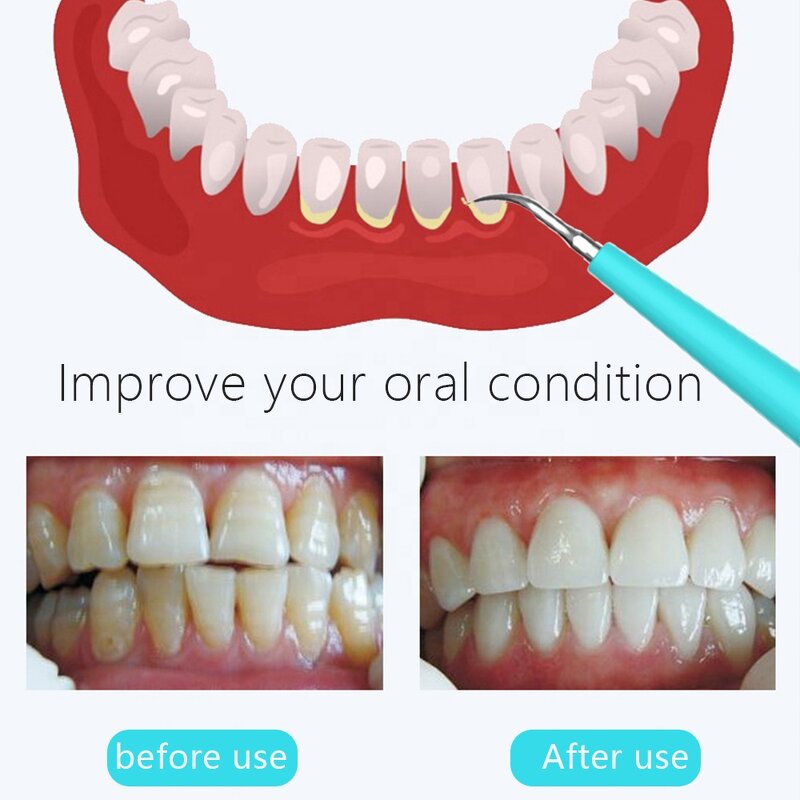 Travel Dental Scaler - New Easy-Carry Waterproof Rechargeable Professional Whitening