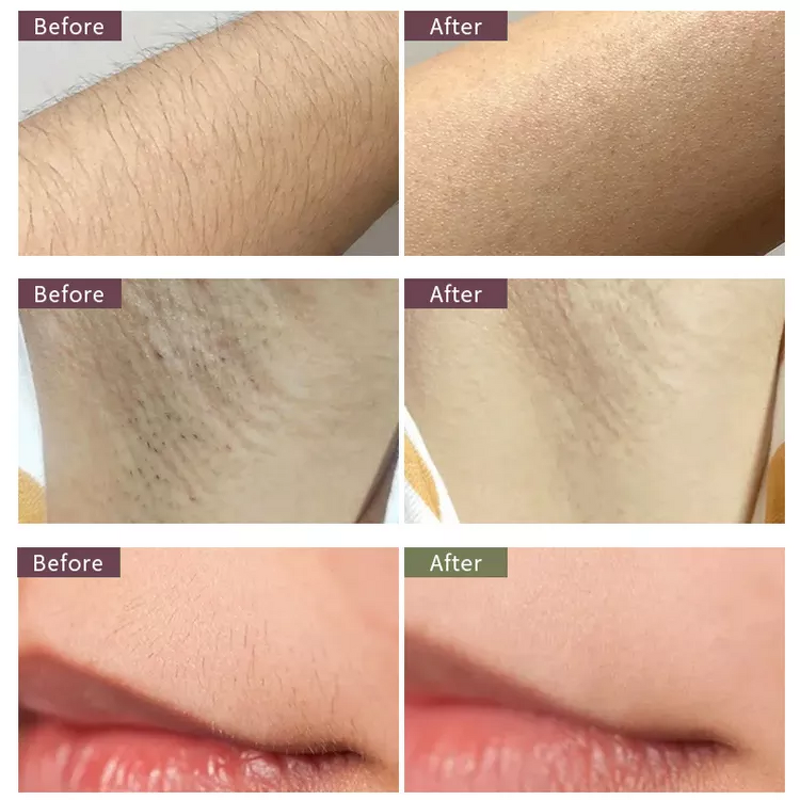 Laser Epilator - 2024 New Trending - Ice and Snow Cooling Leg Body Painless Hair Removal