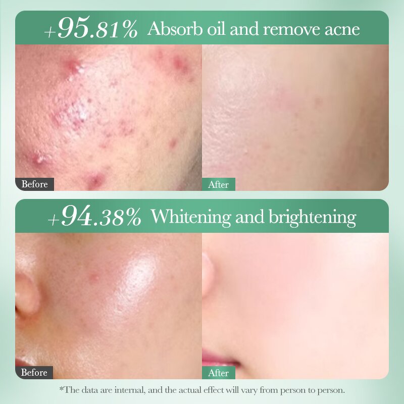 Nud Mask Manufacturer - Salicylic Acid Niacinamide Tea Tree Whitening Anti-acne