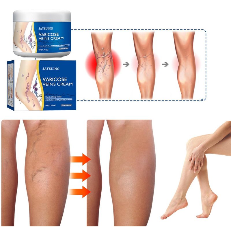 Ointment - Manufacturer Wholesale Varicocele Vasculitis Varicose Vein Cream