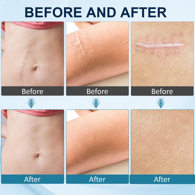 Scar Balm Stick - Manufacturer Private Label 20g Cocoa Butter Vitamin E All Scar