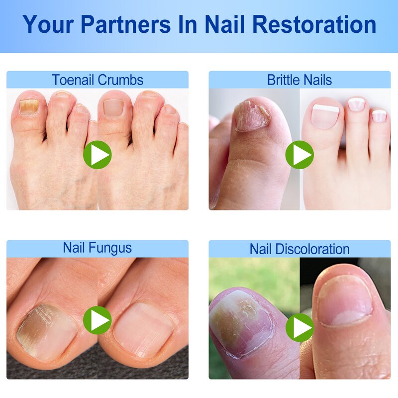 Nail Repair Patches - Manufacturer Multi Purpose Anti Fungal Correction Sticker