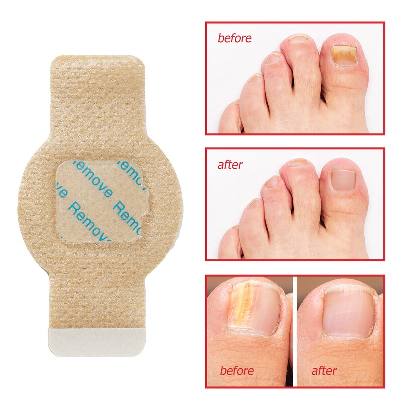 Fungal Nail Patches - Manufacturer Private Label Overnight Repair Anti Fungal