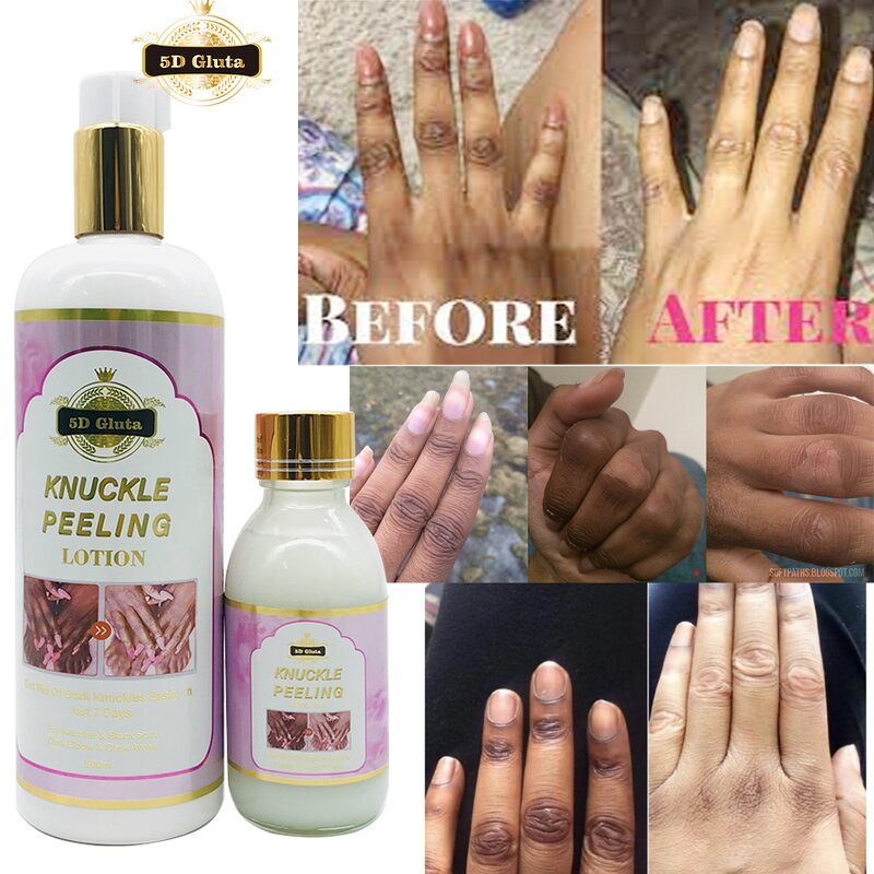 Knuckle Peeling Lotion - Manufacturer Miracle Whitening Elbow Knee Half Cast 500ml