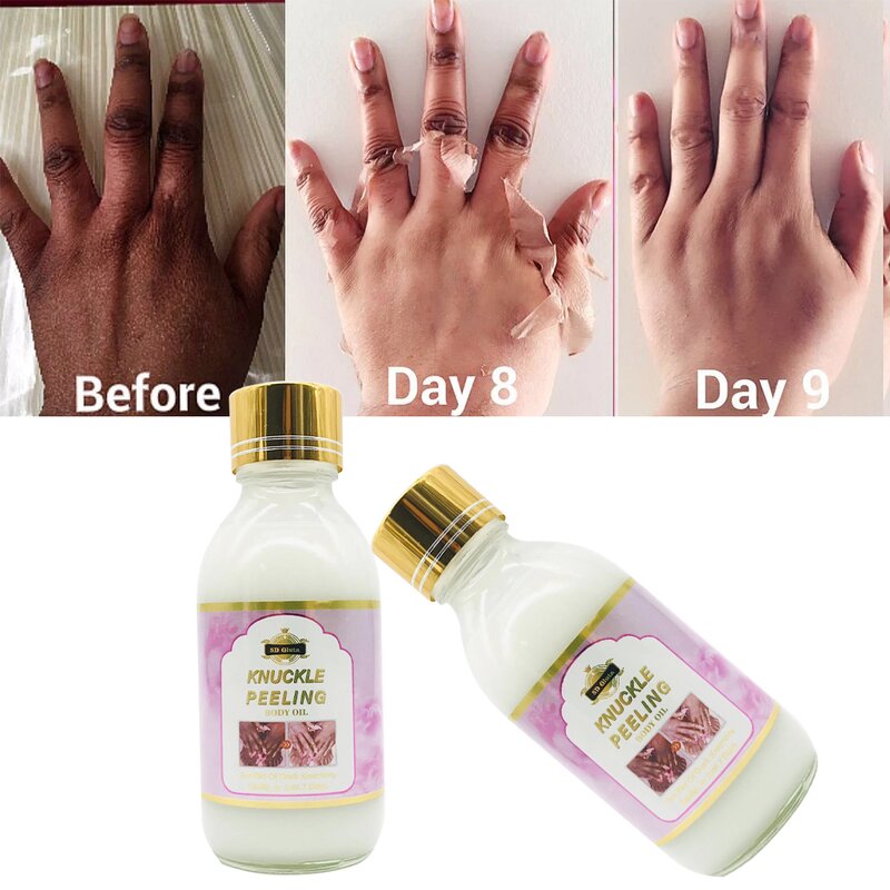 Knuckle Peeling Set - Manufacturer Miracle 7 Days Alpha Arbutin Dark Elbow Africa