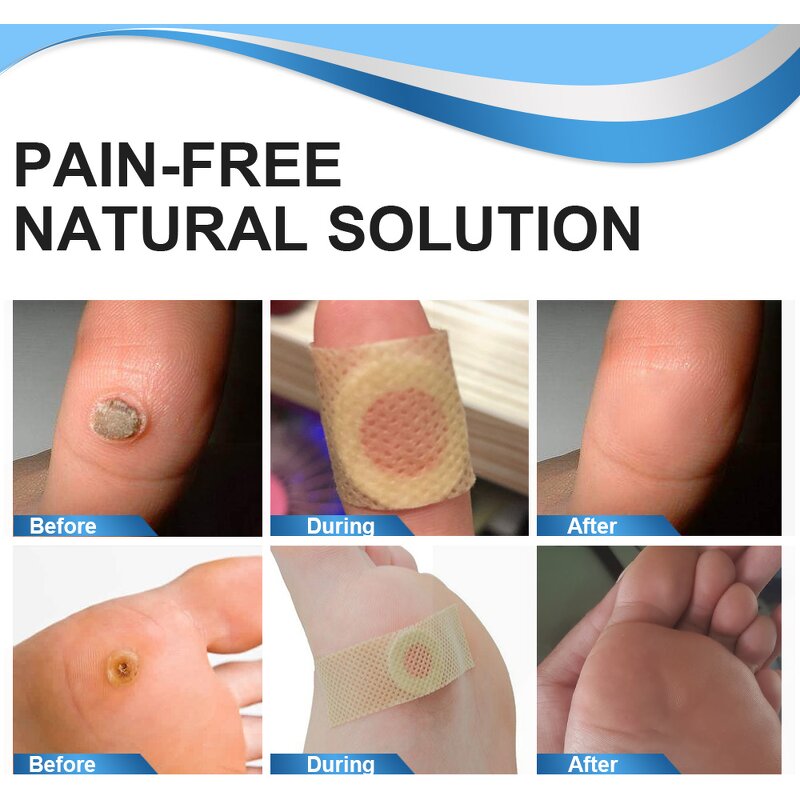 Wart Remover Pad - Wholesale 24 Count Corn Callus Feet Hand Skin Care Solution
