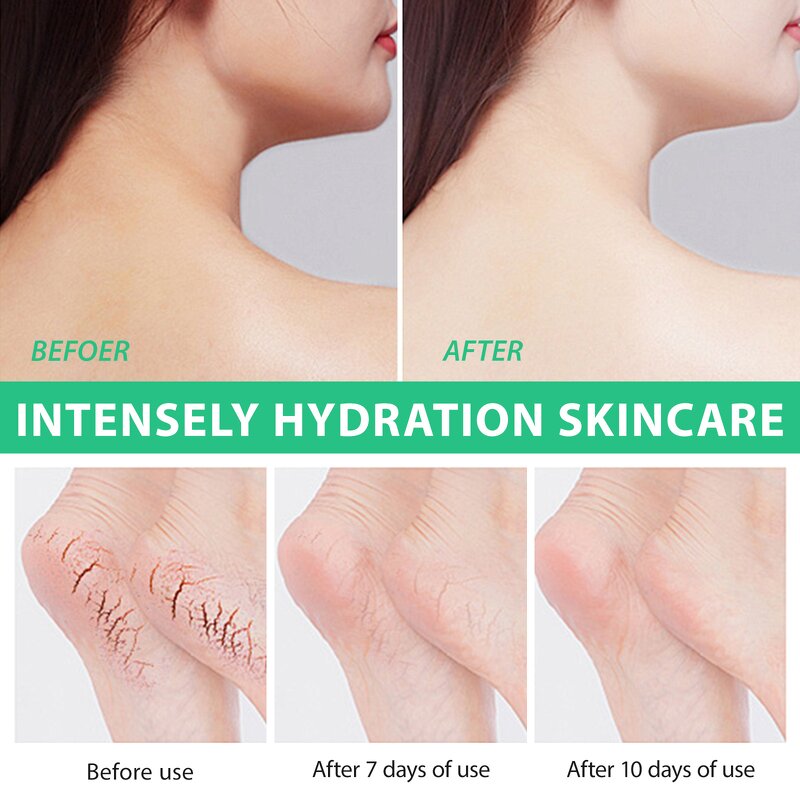 Urea Cream Manufacturer - 40% Urea Foot Repair 2% Salicylic Acid Cracked Heels