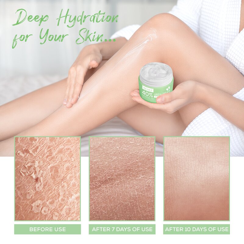 Urea Cream Manufacturer - 40% Urea Dry Cracked Heels Knees Elbows Salicylic Acid