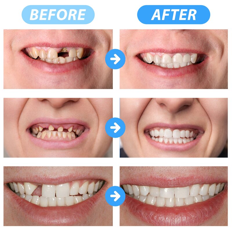 Tooth Repair Kit - 30ml Thermal Fitting Beads Temporary Filling Missing Broken