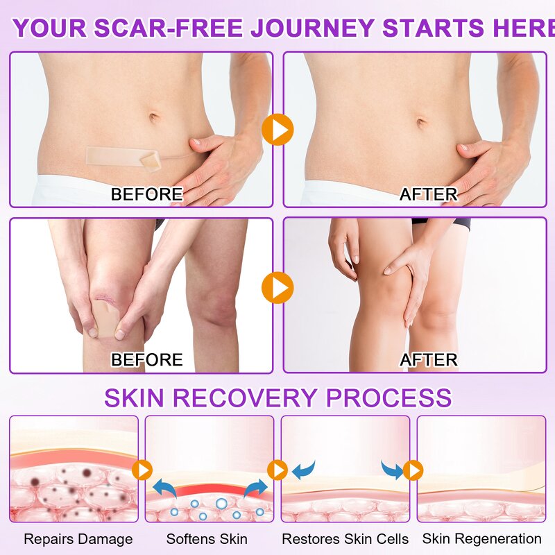 Scar Sheet Manufacturer - Silicone Waterproof Reusable Surgical C-Section Keloid