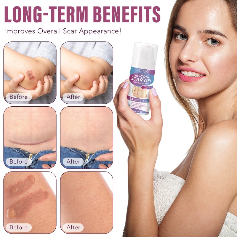 Scar Gel Manufacturer - Premium Skin Care Scar Removal Pimples Acne Silicone Gel