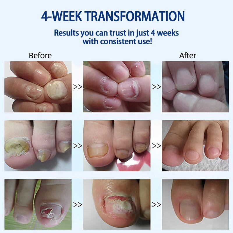 Nail Care Liquid - Wholesale Oregano Tea Tree Plant Drops Toenail Growth Repair