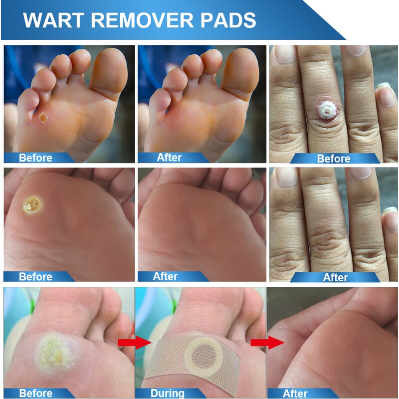 Wart Remover Pad - Wholesale 24 Count Corn Callus Feet Hand Skin Care Solution
