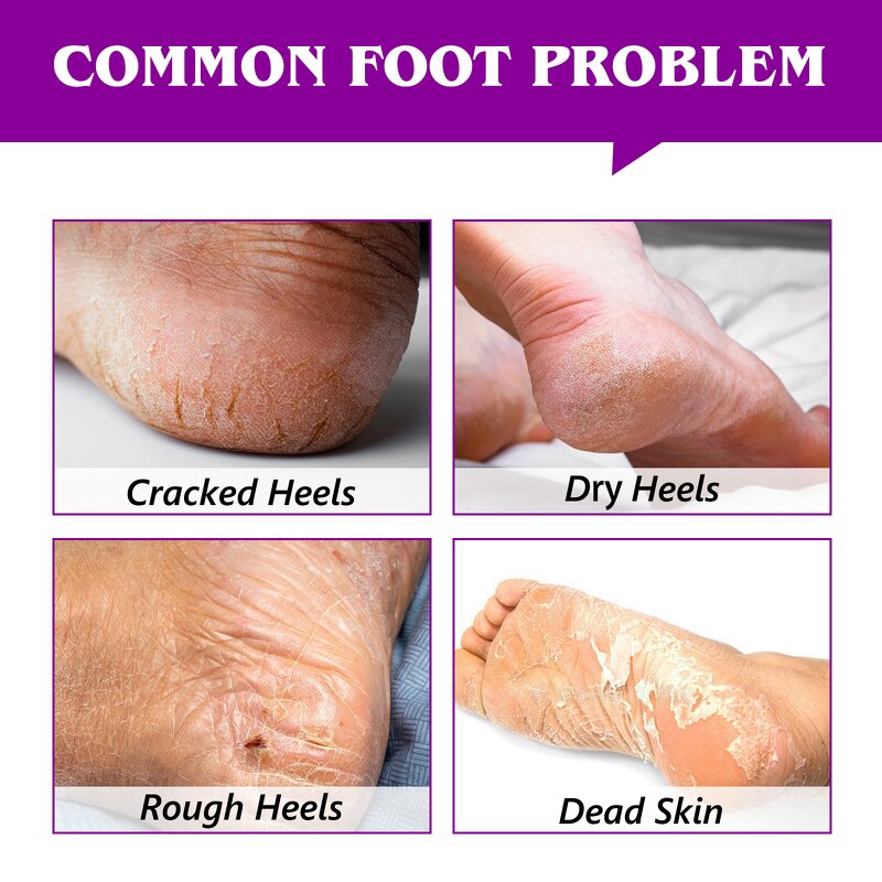 Foot Balm Manufacturer - Professional Deep Moisturizing Cracked Heel Repair Stick