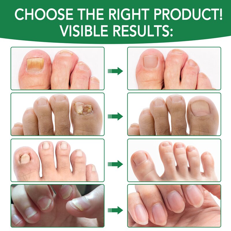 Nail Serum - Wholesale Private Label Toenail Fungus Extra Strength Repair