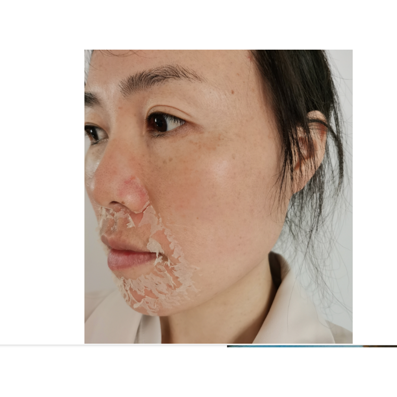 Spongilla Spicules Powder Manufacturer - Bio Microneedling Therapy for Acne & Skin Tightening