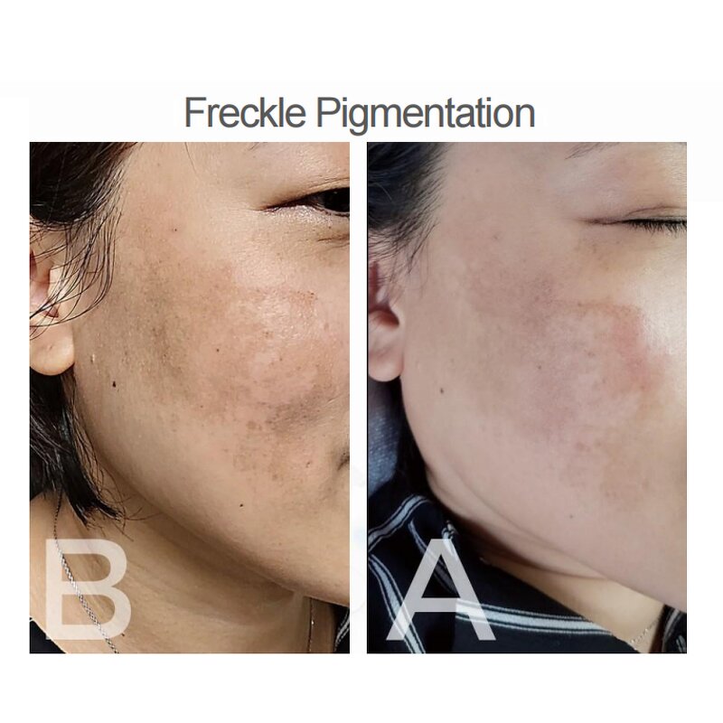 Cold Plasma Machine Manufacturer - B Plasma Beauty Equipment for Acne & Firming