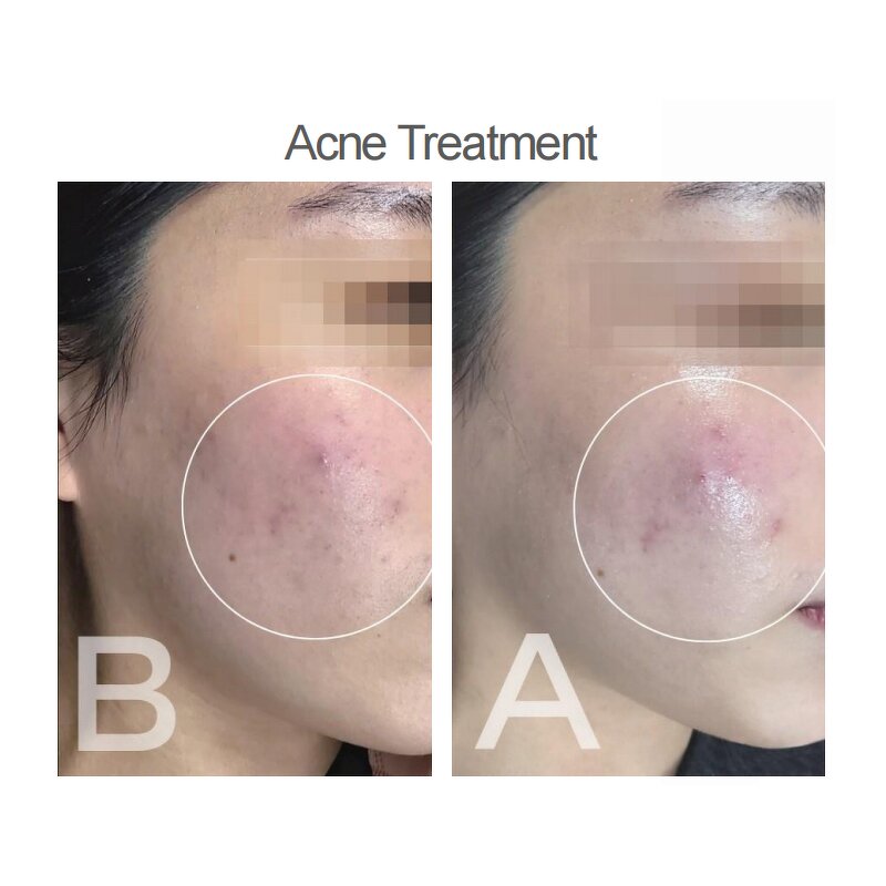 Cold Plasma Machine Manufacturer - B Plasma Beauty Equipment for Acne & Firming