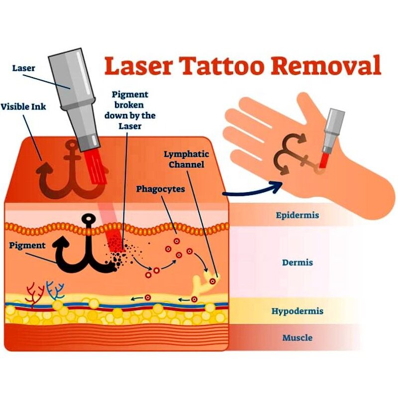 Picosecond Laser Machine Manufacturer - Professional 1320nm/1064nm/532nm Q-switched ND YAG