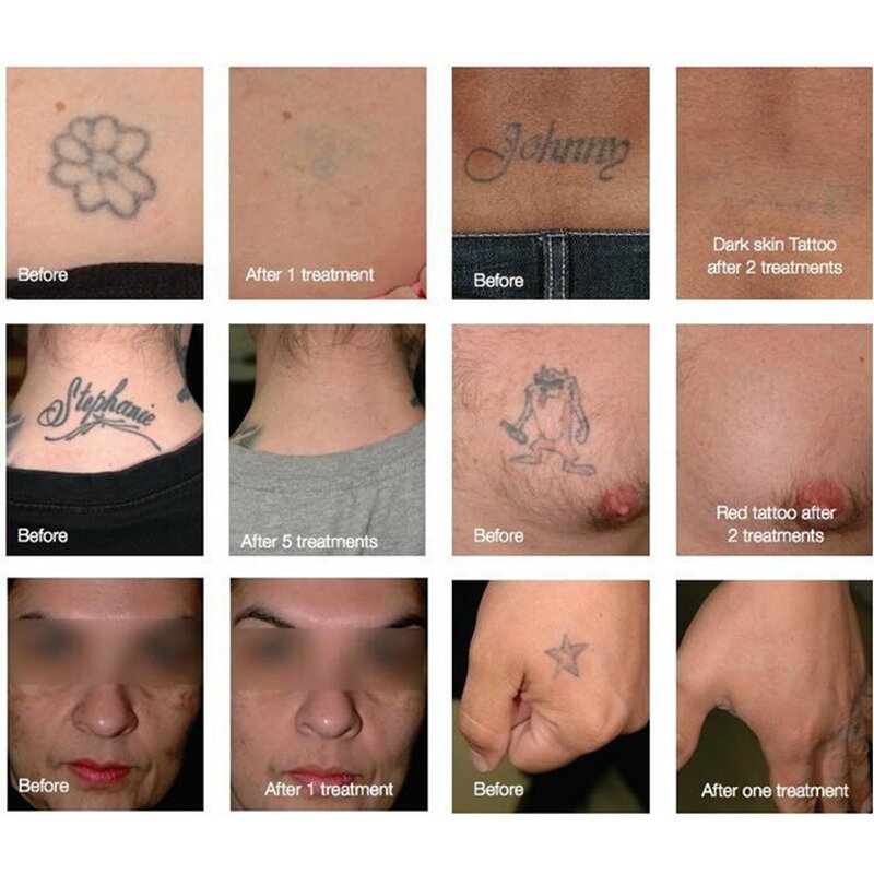 Picosecond Laser Machine Manufacturer - Professional 1320nm/1064nm/532nm Q-switched ND YAG