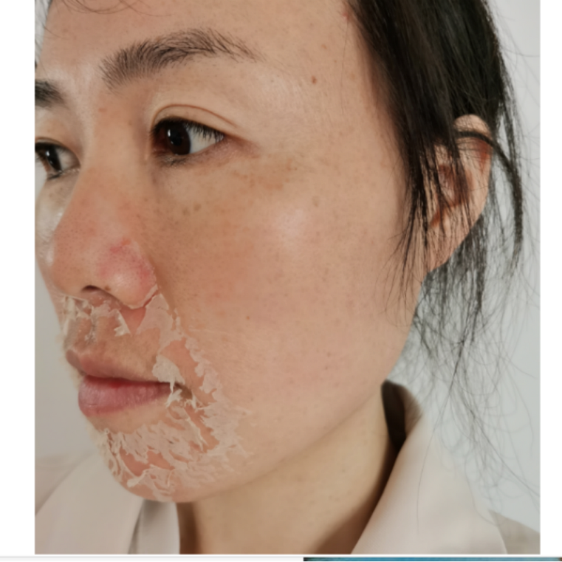 Spongilla Spicule Peel Manufacturer - Anti Aging Seaweed Microneedling Natural Sponge Peel