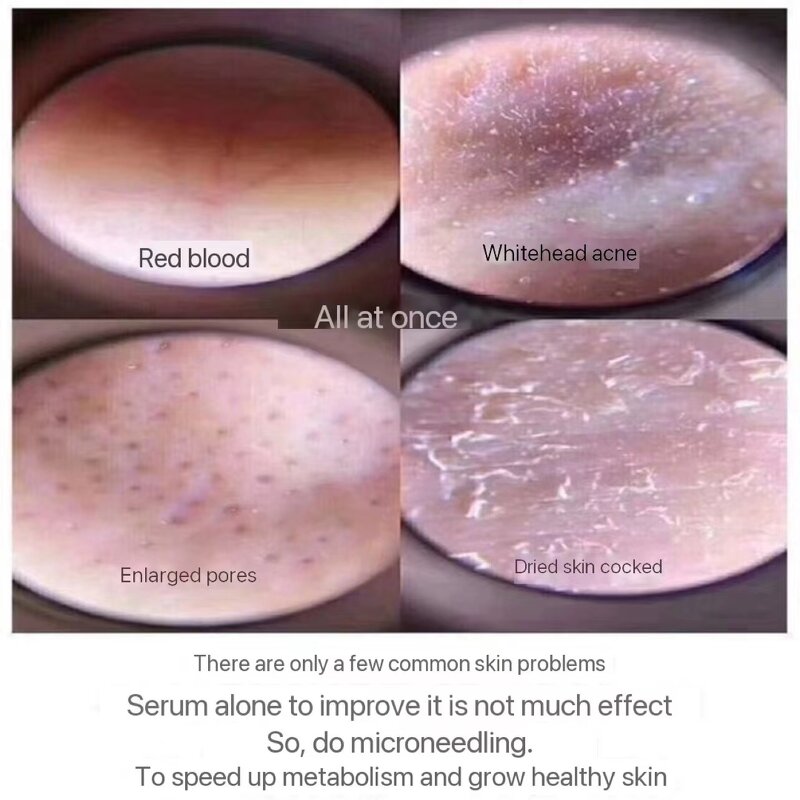 Spongilla Spicules Powder Manufacturer - 2024A Bio Microneedling Therapy for Acne & Tightening