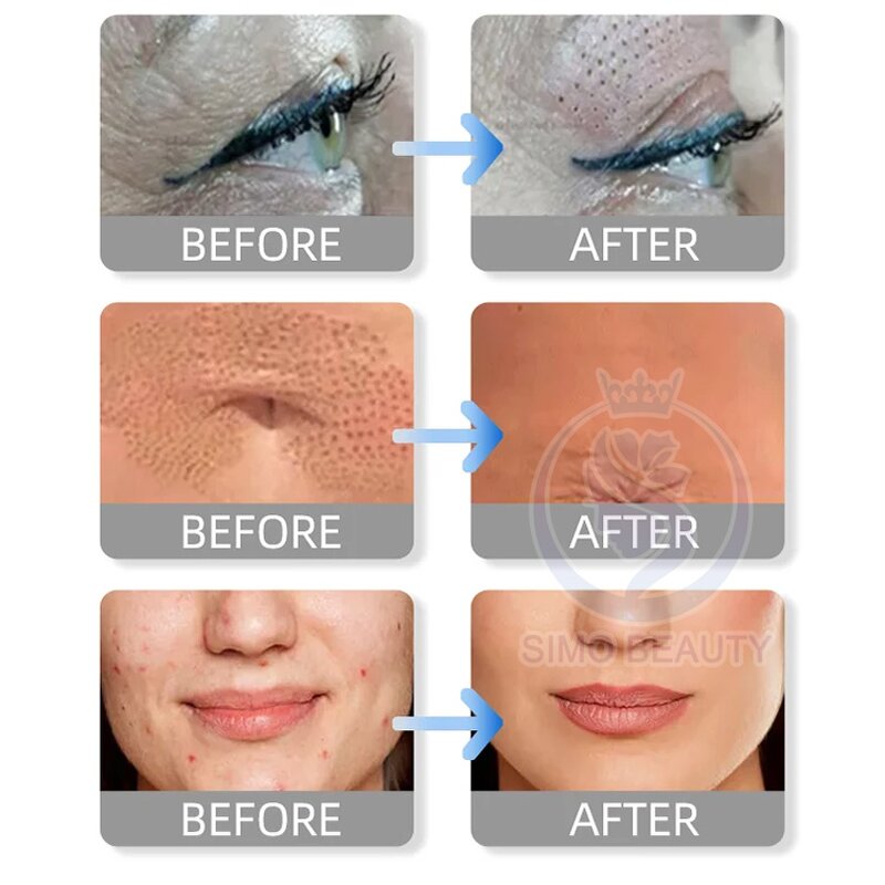 Plasma Pen - Manufacturer - Eyebrow Embroidery Tattoo Removal Korea Large Area