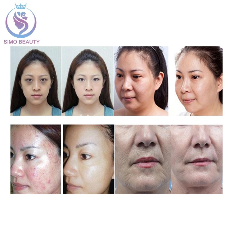 Dr Pen Ultima A6 - Manufacturer - Dermaroller Micro Needle Cartridges 12-36 Pin