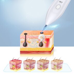 Plasma Laser Pen - Manufacturer - Professional True Skin Tightening Wholesale