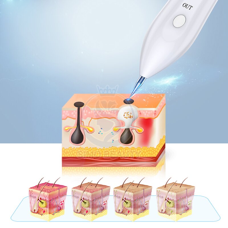 Plasma Laser Pen - Manufacturer - Professional True Skin Tightening Wholesale