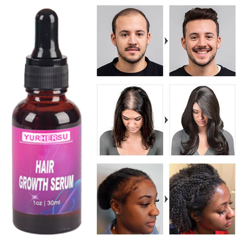Scalp Treatment Oil - Manufacturer - Private Label Organic Anti Loss Hair Growth Stabilization