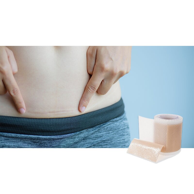 Silicone Scar Strips - Manufacturer - Reusable Self-Adhesive C-Section Scar Tape