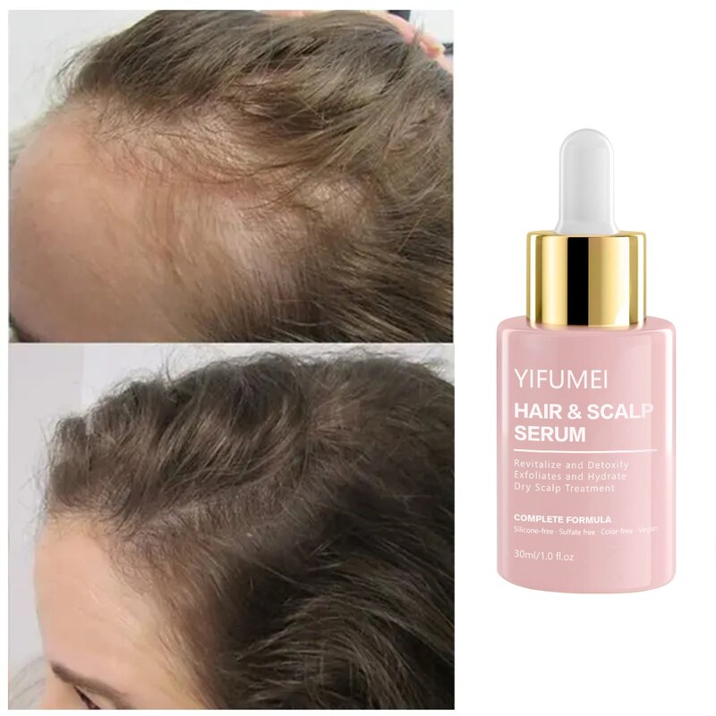 Rosemary Hair Oil - Manufacturer - Private Label Anti Loss Regrowth Hair Growth Treatments Serum