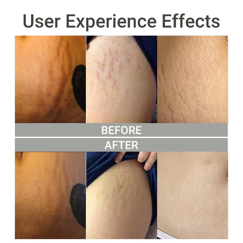 Stretch Mark Cream Manufacturer - Private Label for Pregnancy Anti Mark