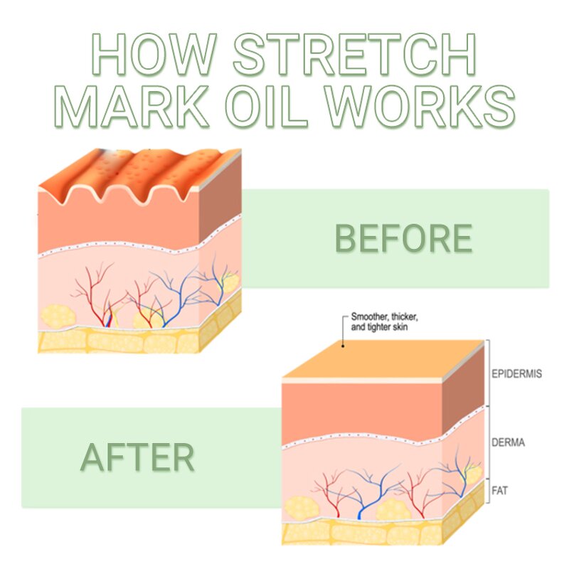 Stretch Marks Oil Manufacturer - Whitens Naturally for Scars & Marks