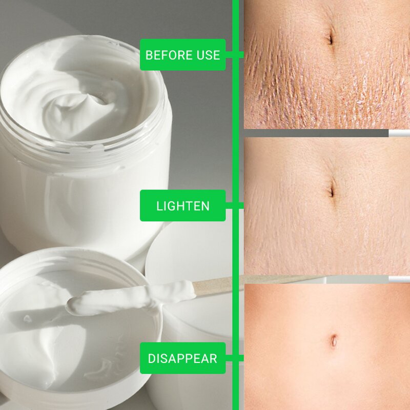 Stretch Mark Cream Manufacturer - Private Label for Pregnancy Anti Mark