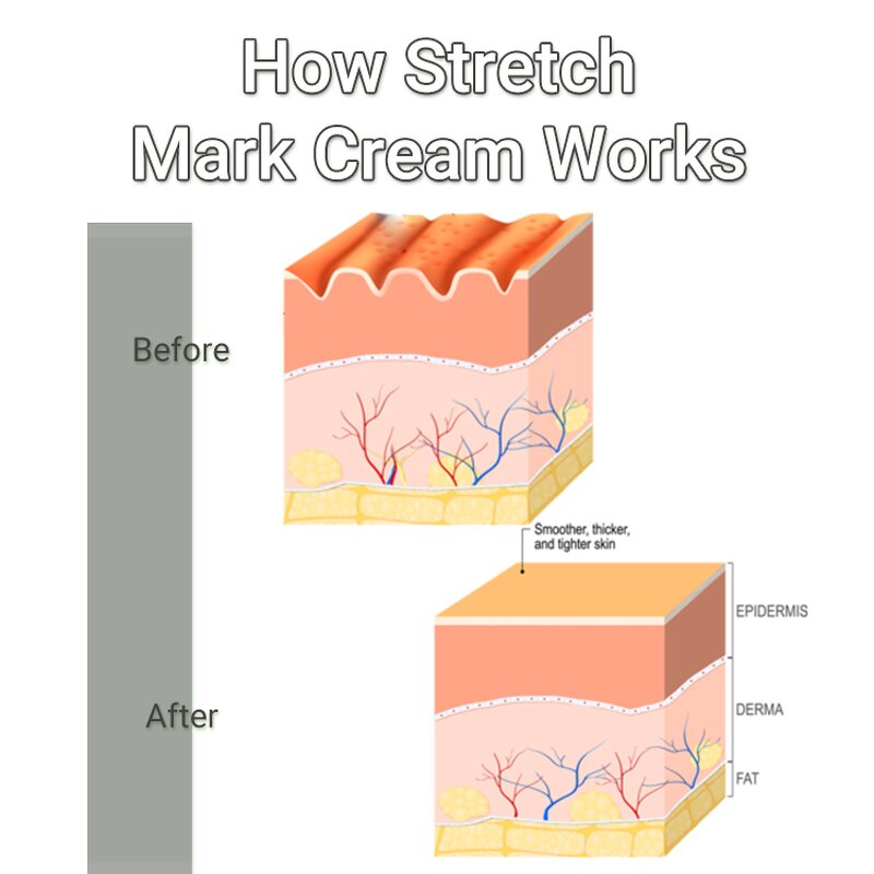 Stretch Mark Cream Manufacturer - Private Label for Pregnancy Anti Mark