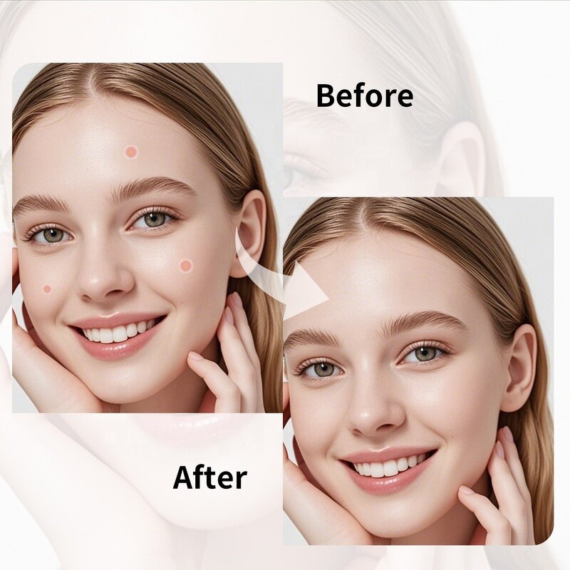 Acne Pimple Patch - Manufacturer - Private Label 180Pcs Cute Star Hydrocolloid for Face