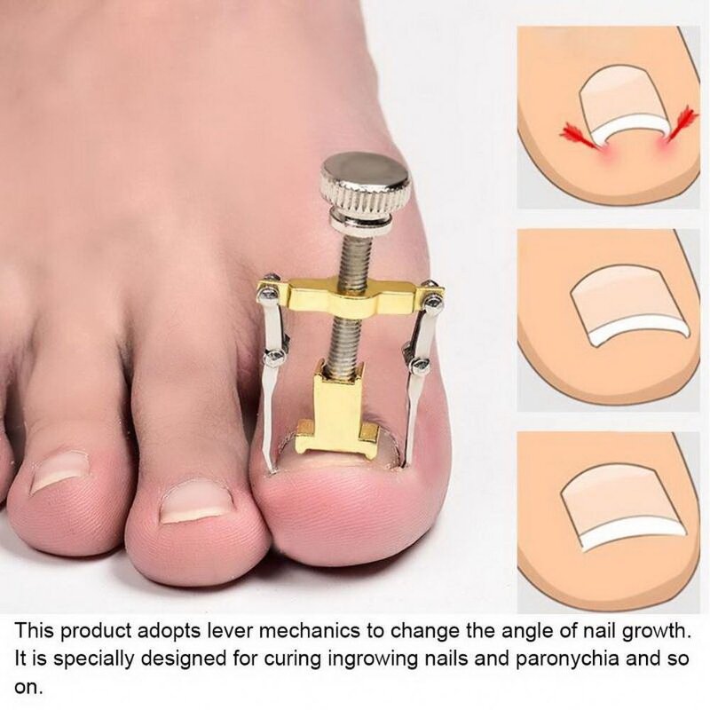 Toe Nail Tool Manufacturer - Ingrown Correction Brace Pedicure