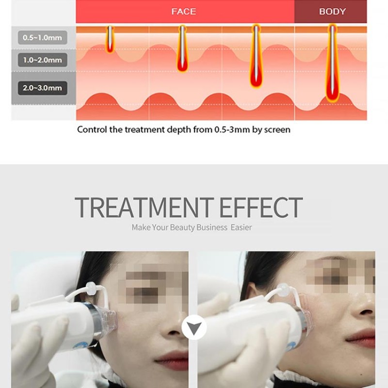 RF Electric DermaPen Factory - Microneedle Roller 0.25mm-2.0mm