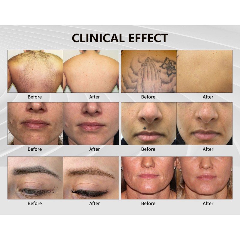 808 Diode Laser Machine Supplier - Elight Skin Rejuvenation