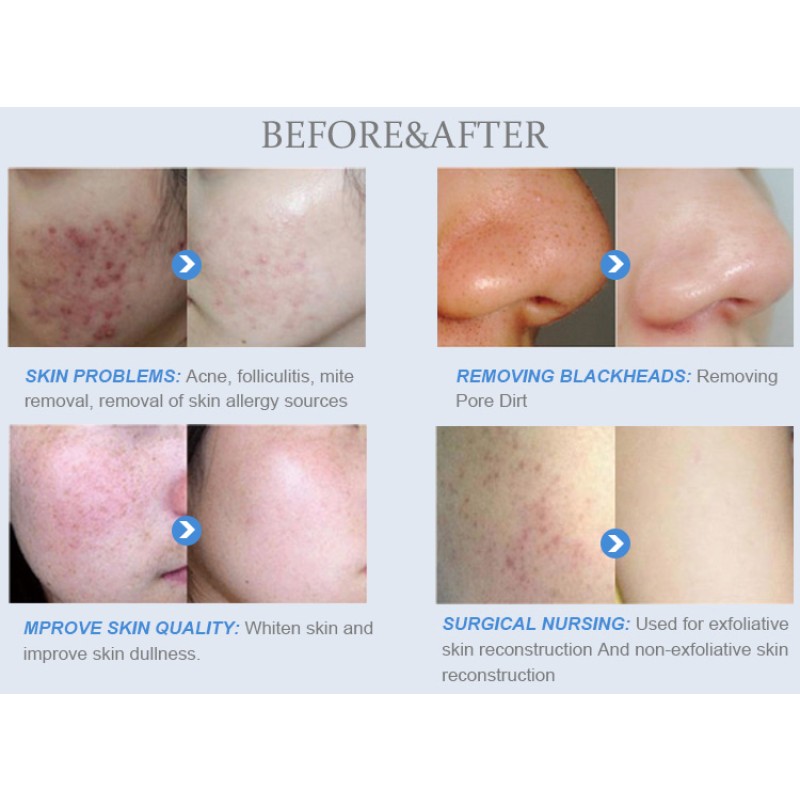 Salon-Grade Hydra Skin Refiner Supplier - US Plug Hydrodermabrasion