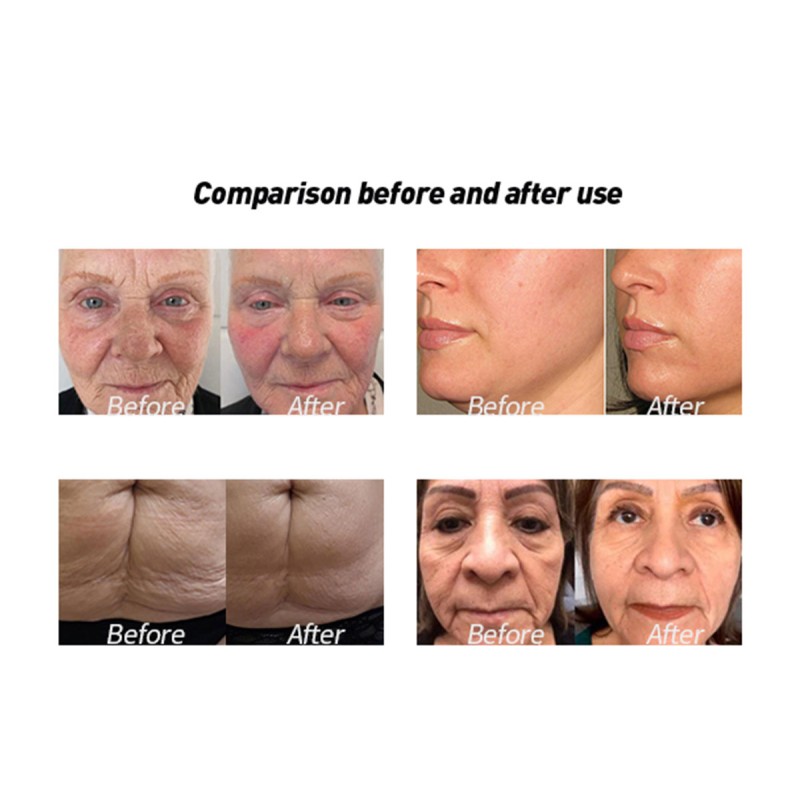 Anti-Aging RF Lifting Machine Factory - Vacuum Roller Cavitation