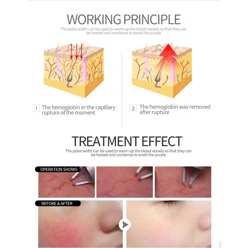 2-in-1 Diode Laser Machine Supplier - 980nm Hifu Nail Fungus