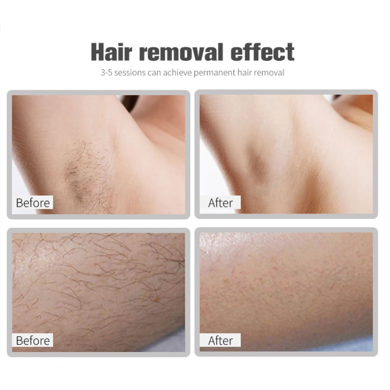 2025 Hair Removal Laser Machine Manufacturer - 1800W Ice Titanium