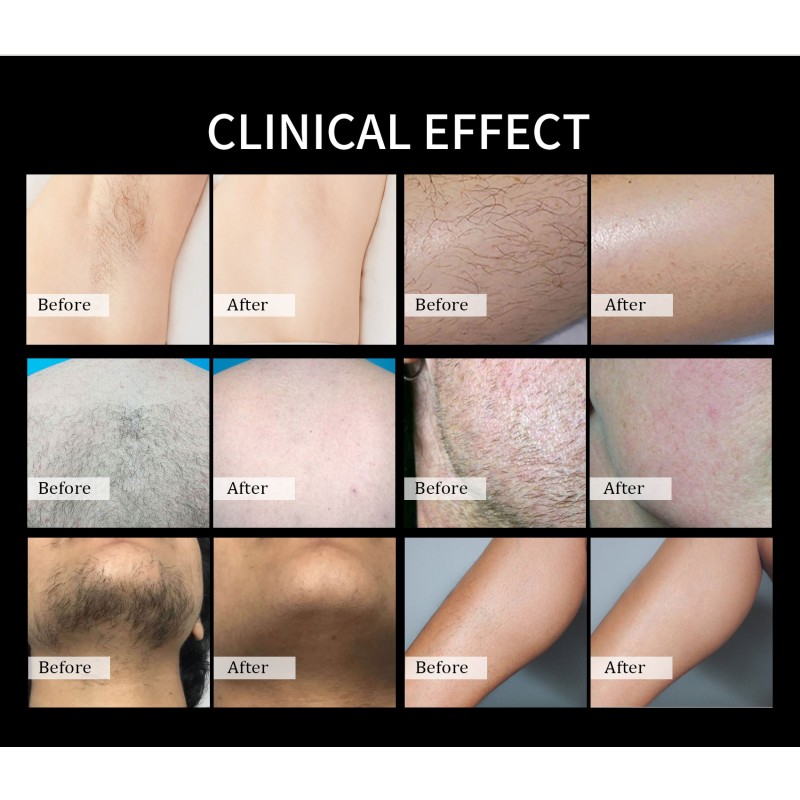 CE Approved Diode Laser Machine Factory - Triple Wave 3D Ice