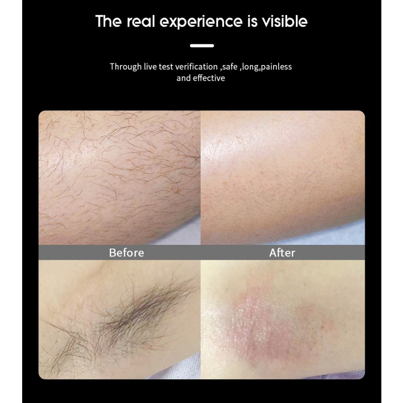 Diode Laser Hair Removal Machine Supplier - 755 808 1064nm 808nm